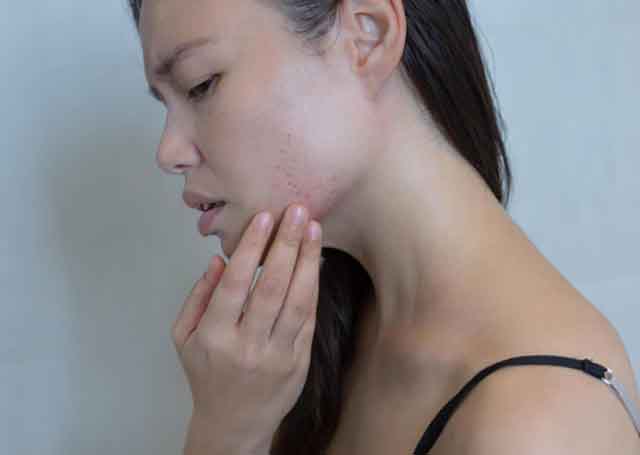 Woman with acne breakout, a sign she needs probiotics